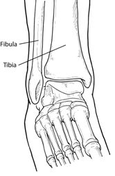 Ankle Fracture 1
