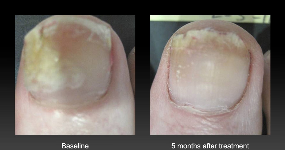 Nail Fungus Laser Treatment Before & After