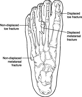 big toe stress fracture