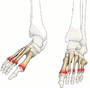 Metatarsalgia